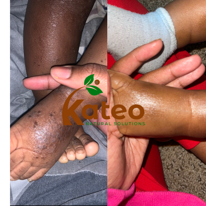 Advanced Eczema Support Bundle