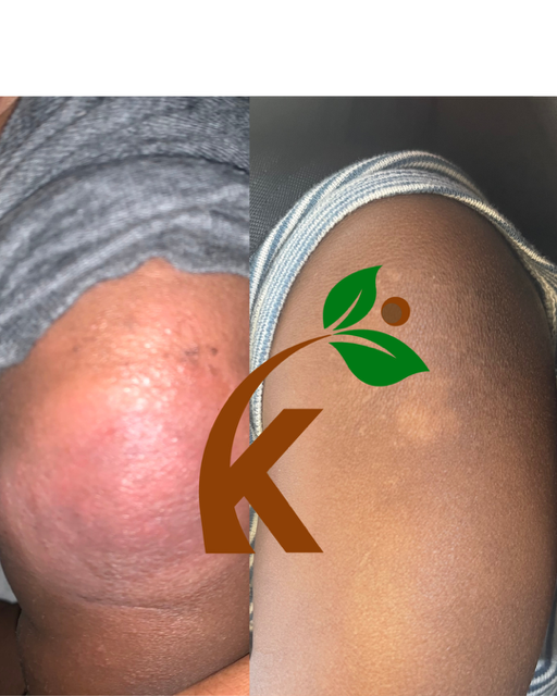 Advanced Eczema Support Bundle